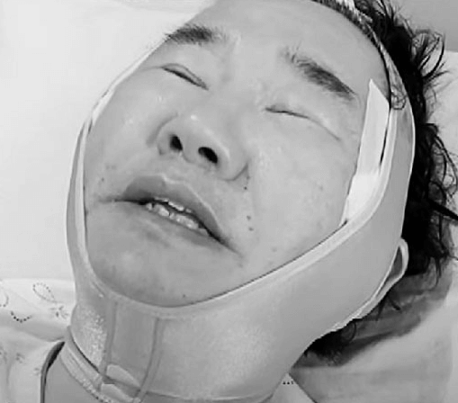 62세 최양락 안면거상 놀라운 변신